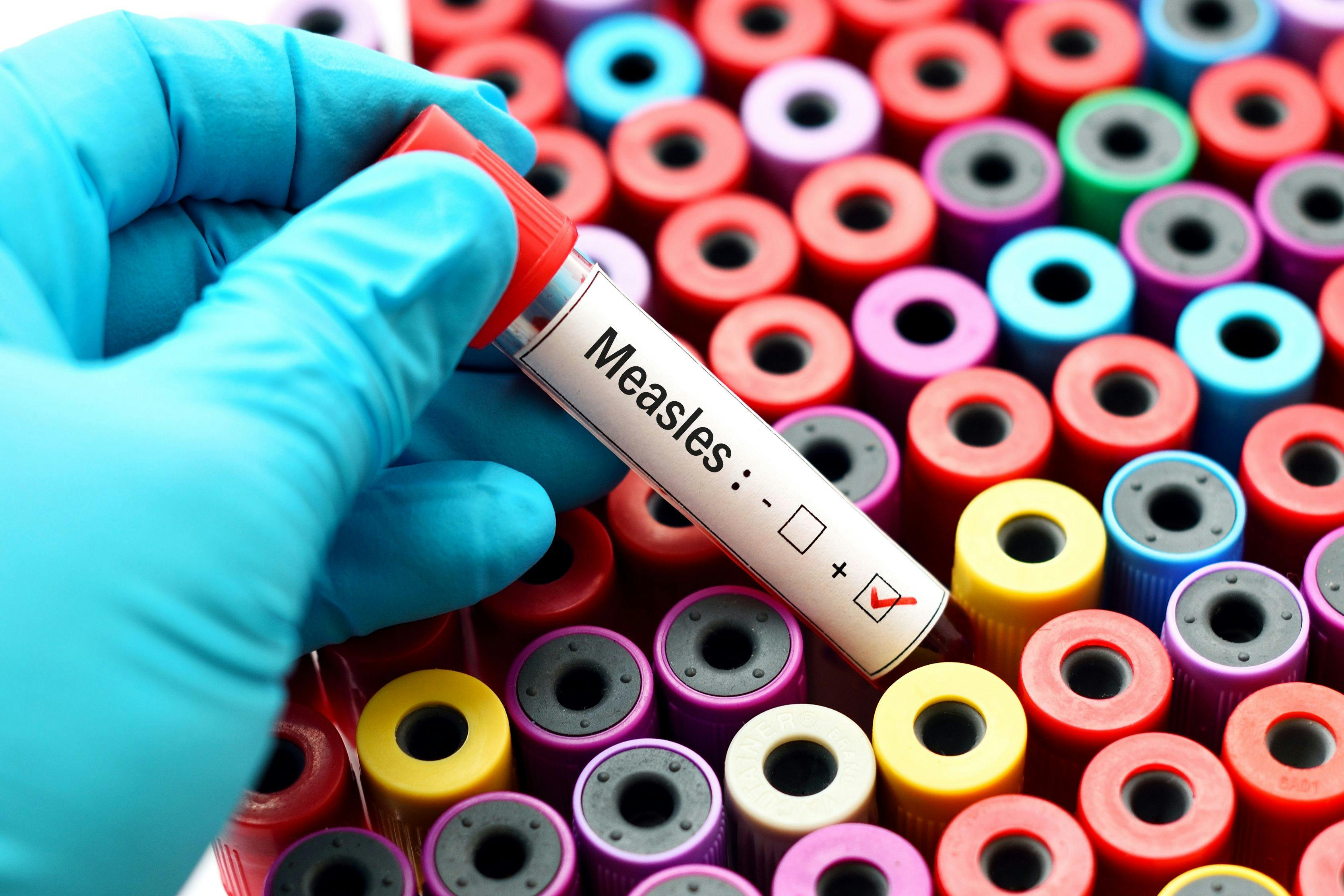 CDC: More measles cases reported in 2024 than all of 2023 | Image Credit: © jarun011 - © jarun011 - stock.adobe.com.