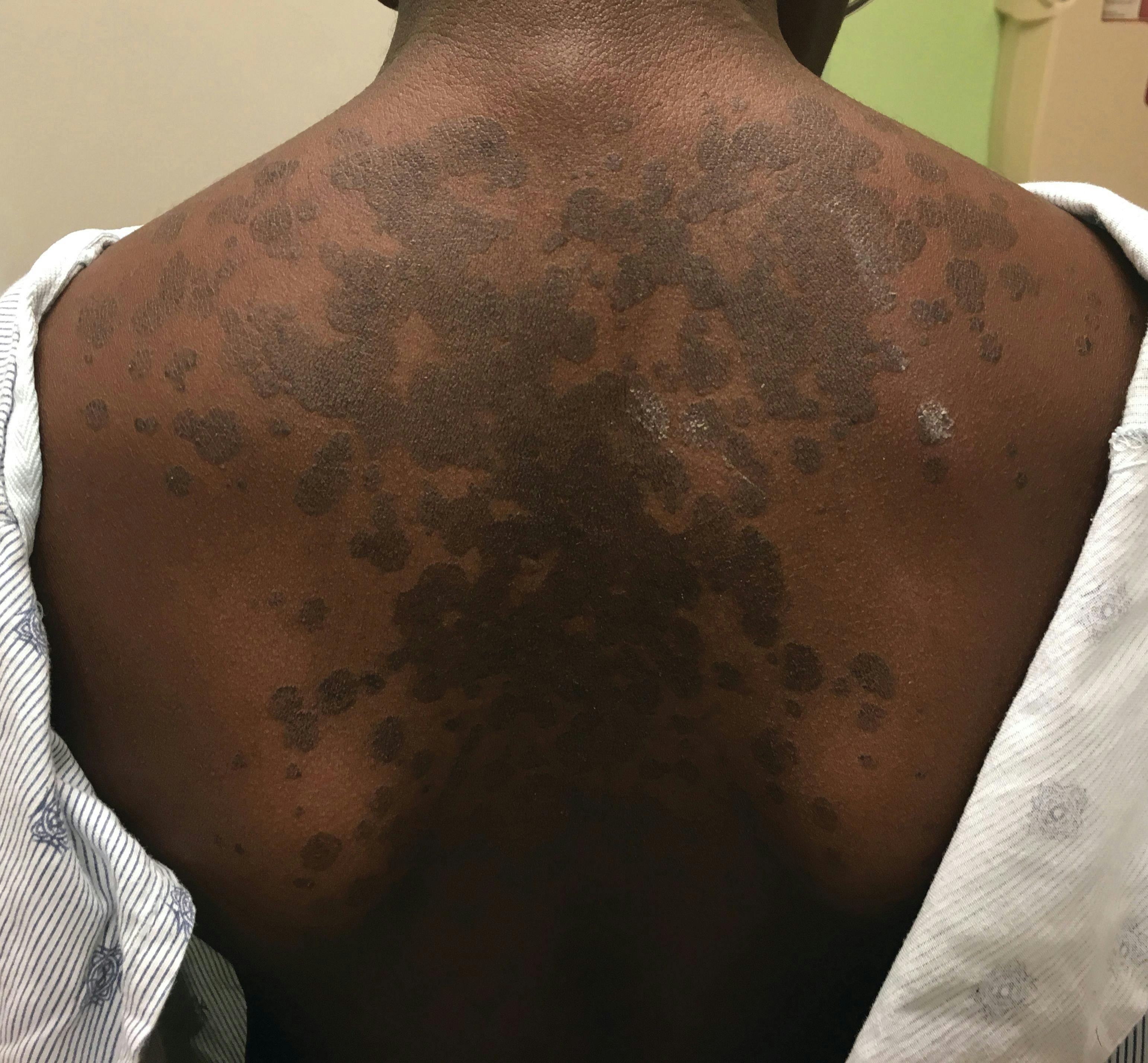 A 13-year-old girl with welldemarcated rash on back and chest | Image Credit: © Author provided - © Author provided  - stock.adobe.com.