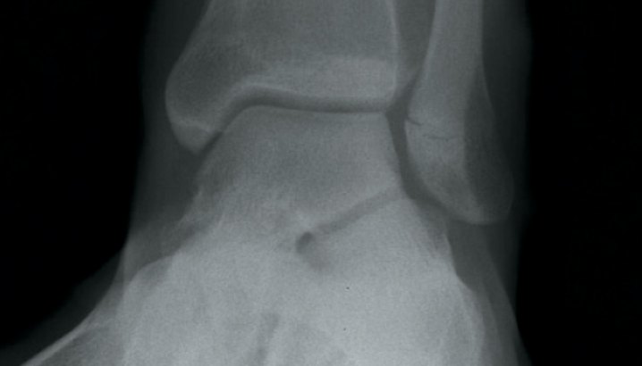 Teenager with ankle pain and swelling