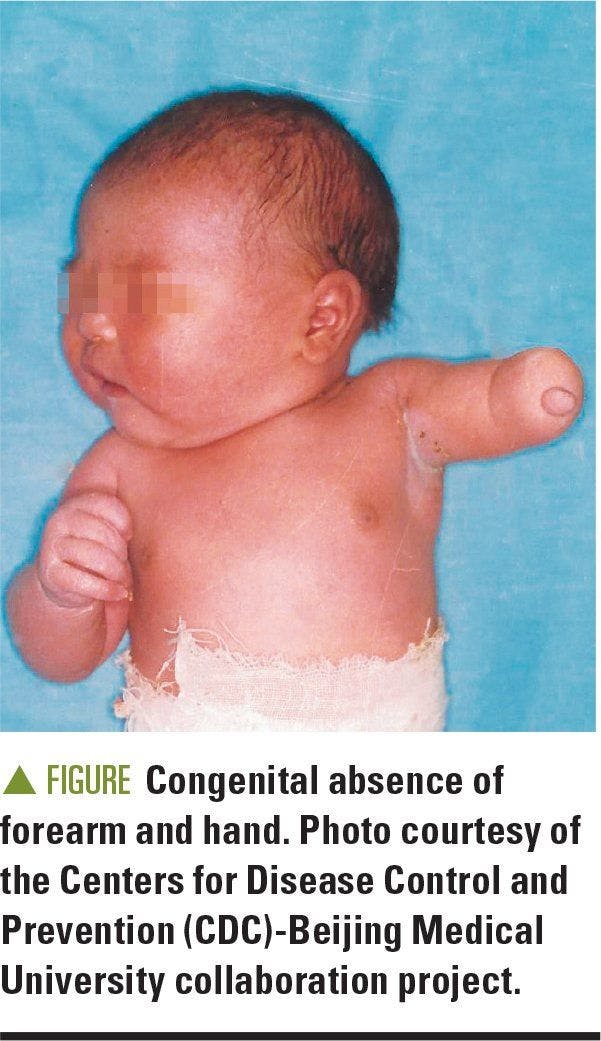 Image of infant with congenital absence of forearm and hand