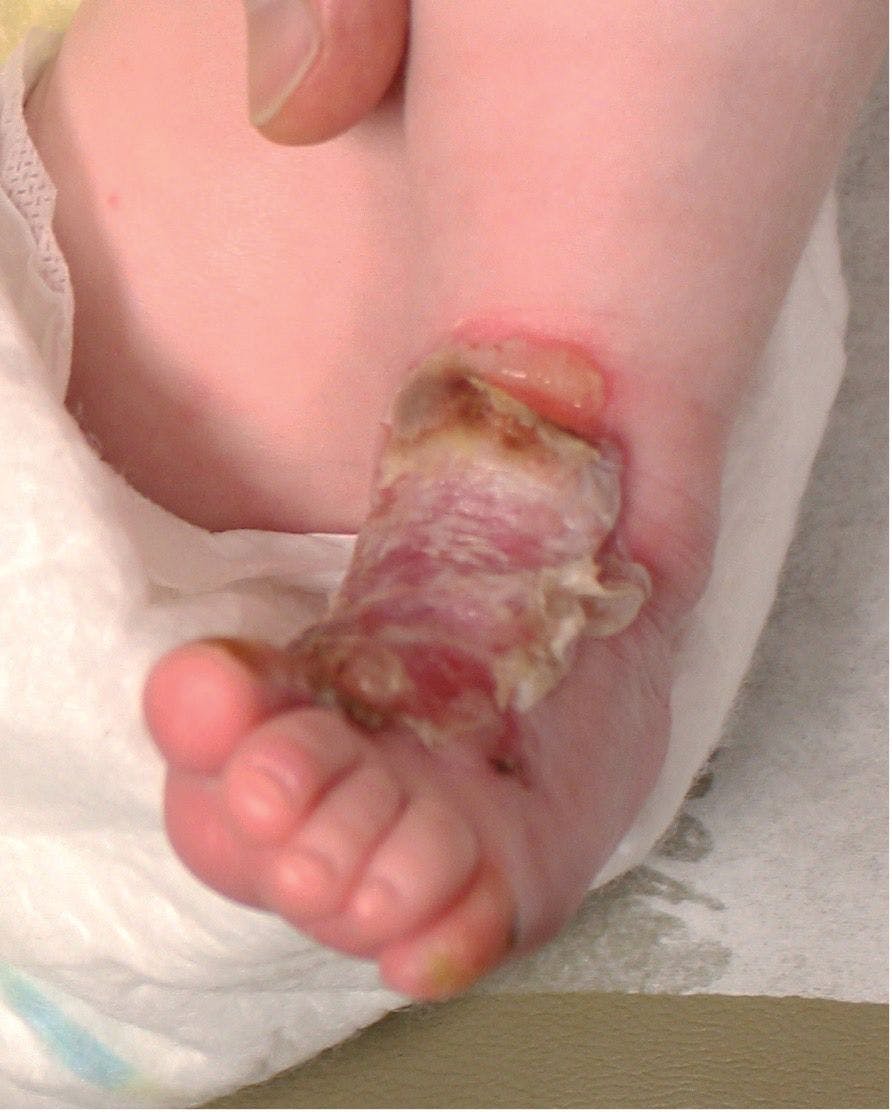 Friction-induced blistering on a child’s feet 