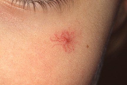 Spider Angioma on child's face
