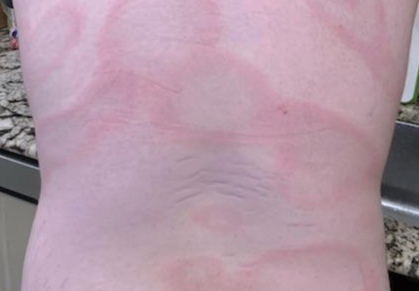 Disseminated erythema migrans as a result of Lyme disease