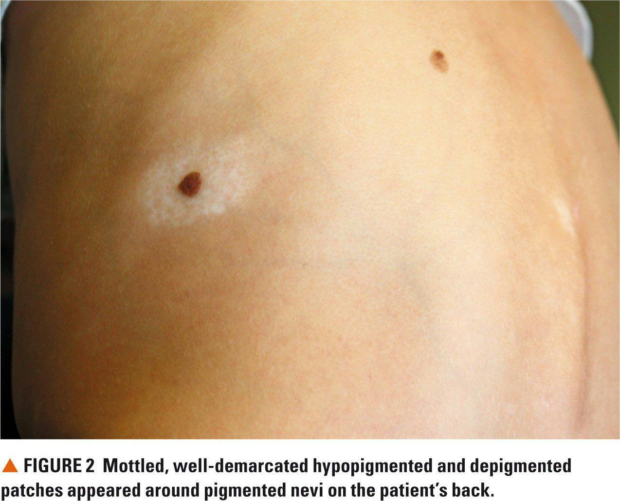 Figure 2. Mottled, well-demarcated hypopigmented and depigmented patches appeared around pigmented nevi on the patient's back.