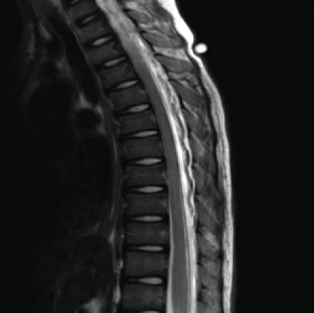 Boy presents with fatigue, minimal responsivity, and diffuse muscle weakness