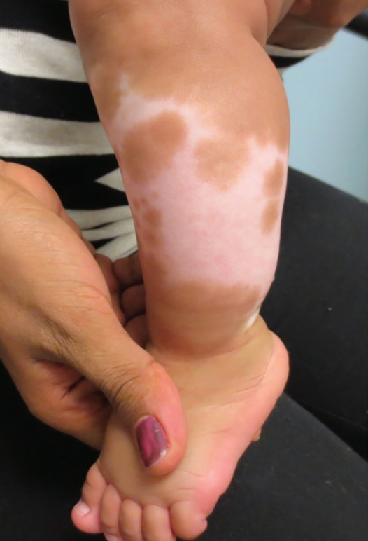 Exploring the treatment landscape for pediatric vitiligo