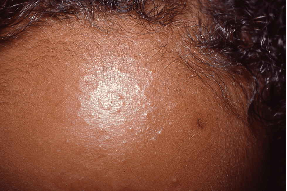 1-month-old boy with annular, red plaques on his scalp and face | Image credit: Author provided