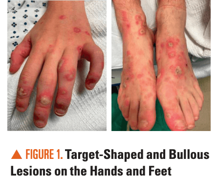 Diffuse targetoid and bullous skin lesions, mucositis, and ocular discharge in an adolescent male | Image Credit: Author provided