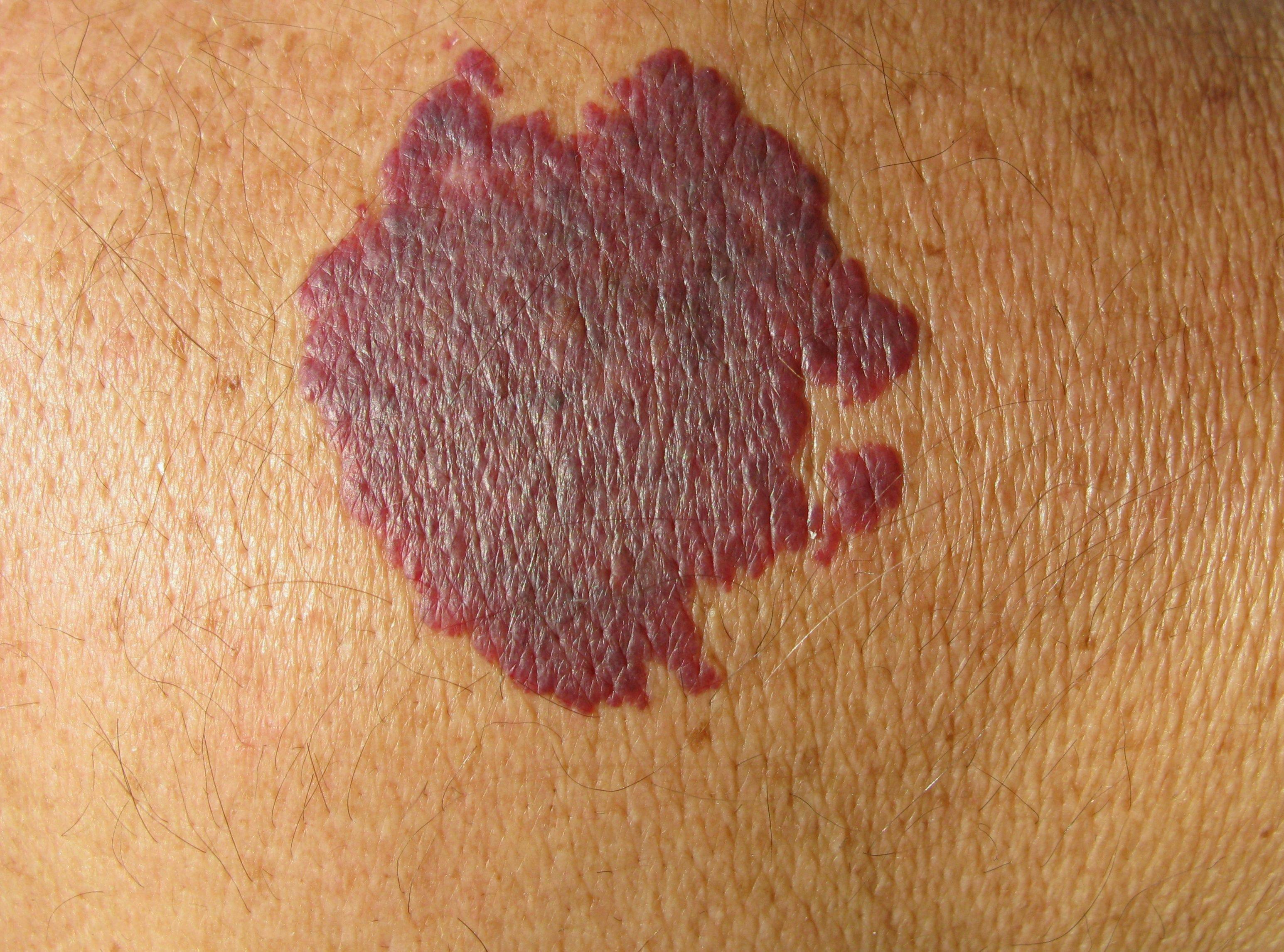 Weekly PDL treatments associated with improved port-wine birthmark therapeutic outcomes in infants | Image Credit: © guentermanaus - © guentermanaus - stock.adobe.com.