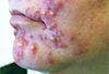 Acne: Options Beyond Oral Antibiotics When Your Patient is “Breaking out” (Video: 5:26 minutes)