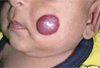 Congenital Hemangiomas: When -- and How -- to Excise (Video: 3:30 minutes)