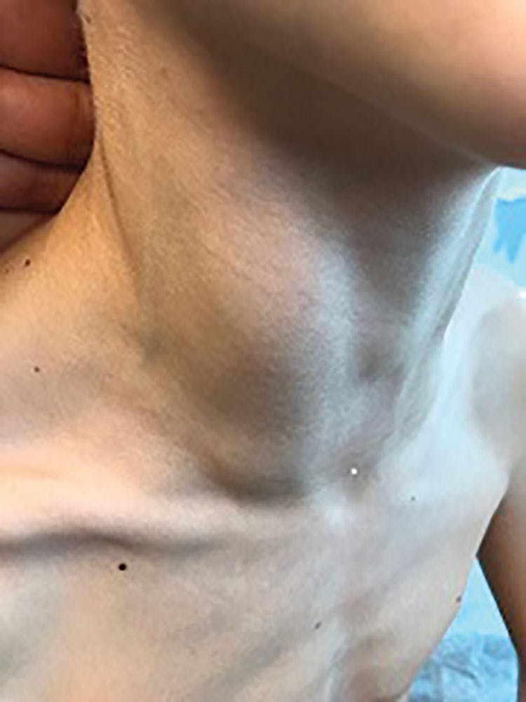 A 9-year-old boy  presents with neck mass