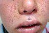 Tuberous Sclerosis in a 10-Year-Old Boy