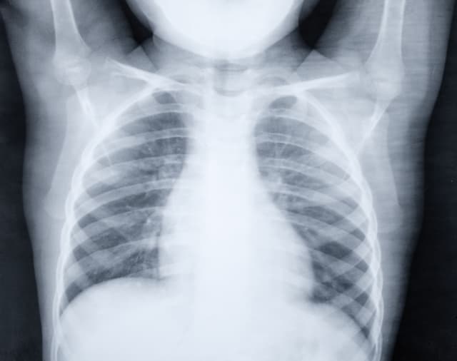 Pediatric pneumonia: Antibiotic use and treatment failureLatest revision | Image Credit: © dimas830 - © dimas830 - stock.adobe.com.