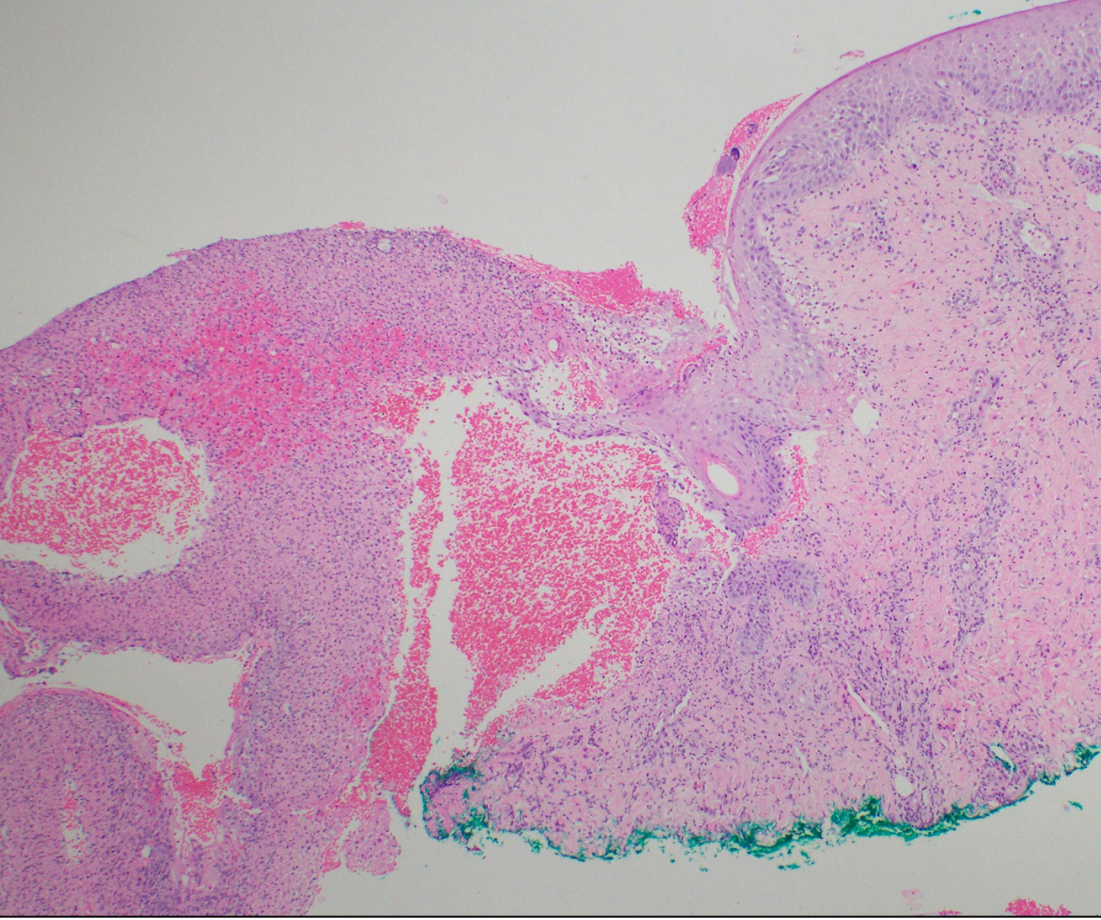 Figure 2 - Histopathology of Vulvar Ulcer - There is epidermal ulceration with dermal perivascular and interstitial mixed inflammation. (Click to zoom)