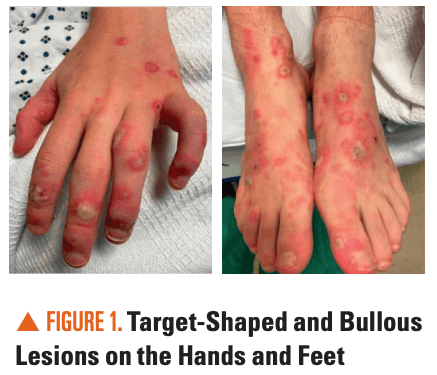 Diffuse targetoid and bullous skin lesions, mucositis, and ocular discharge in an adolescent male | Image Credit: Author provided